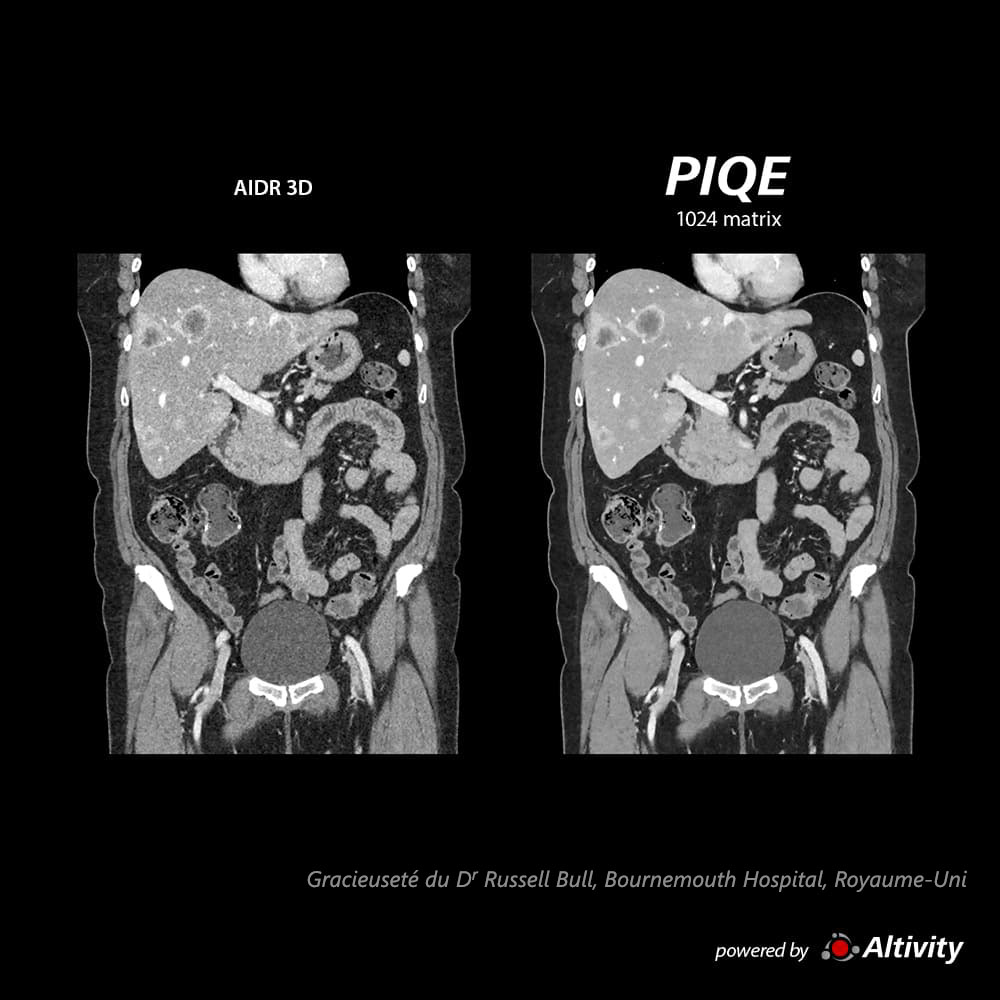 Piqe Cg Abdomen Abdomen en phase veineuse