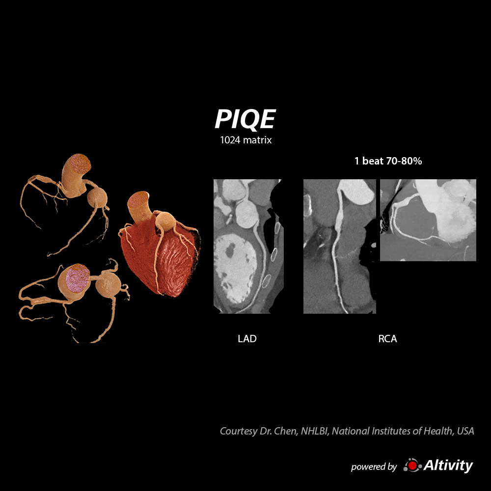 Aneurysms HR 60bpm