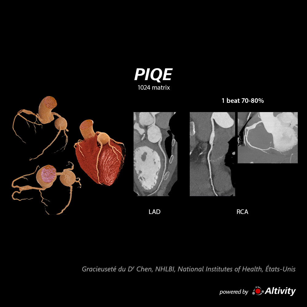 Piqe Cg Cardiac Anévrismes FC 60 bpm