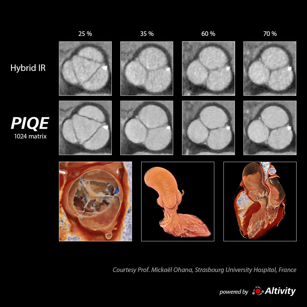 4D Aortic Valve