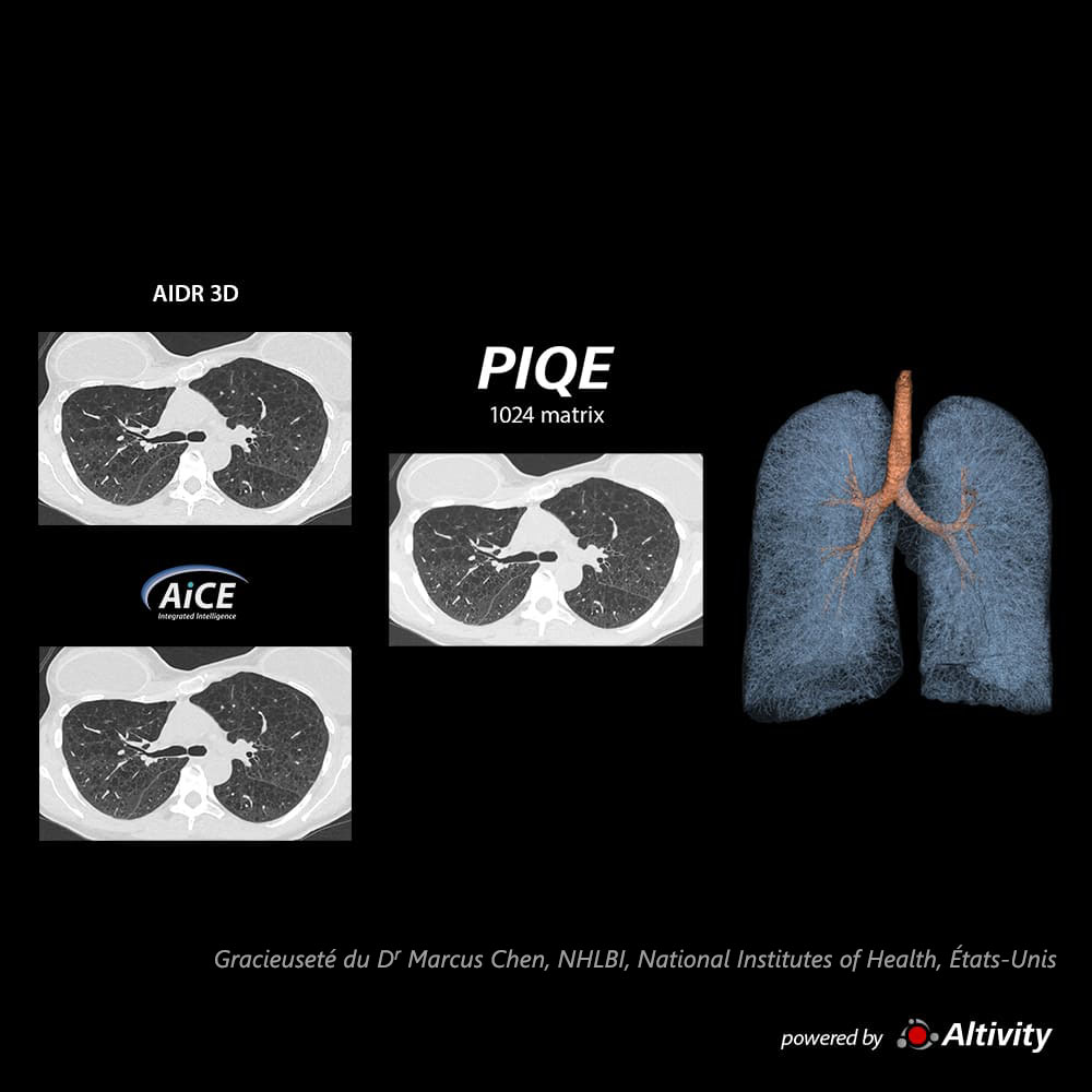 Piqe Cg Lung Maladie pulmonaire kystique