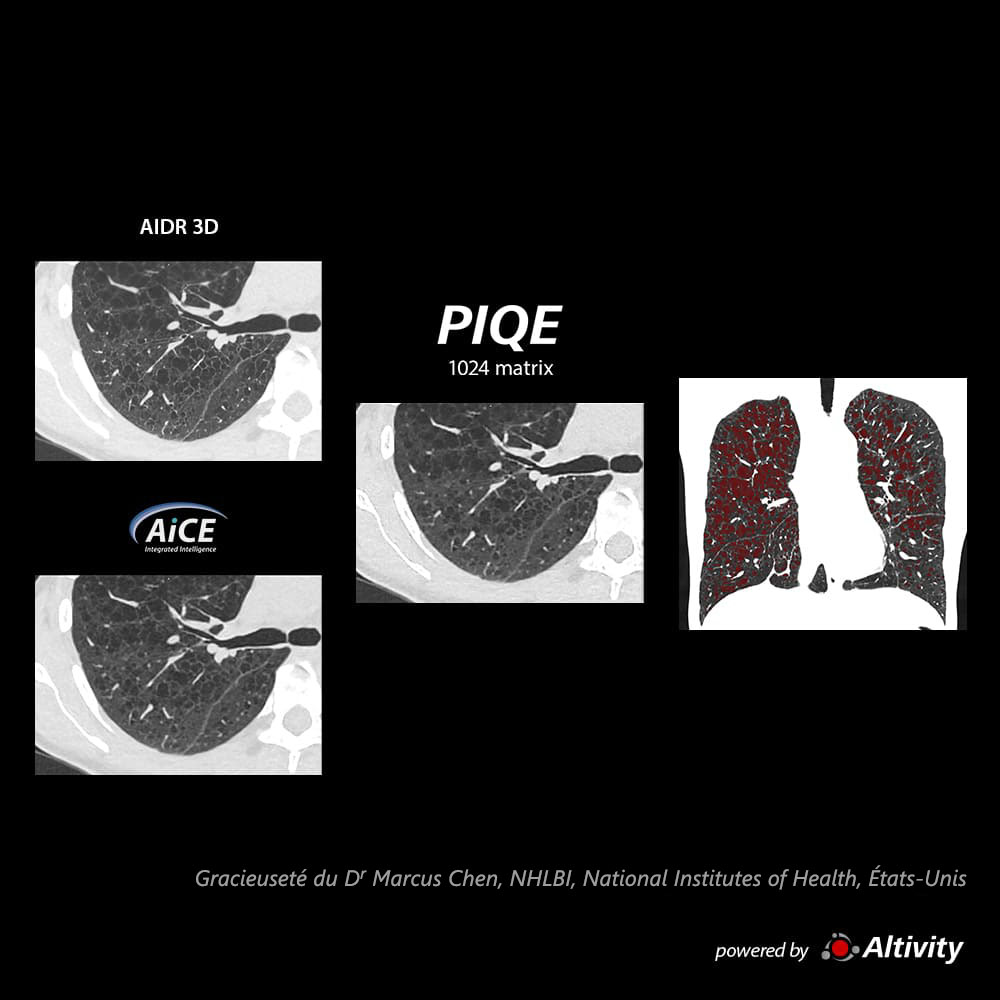 Piqe Cg Lung Maladie pulmonaire kystique