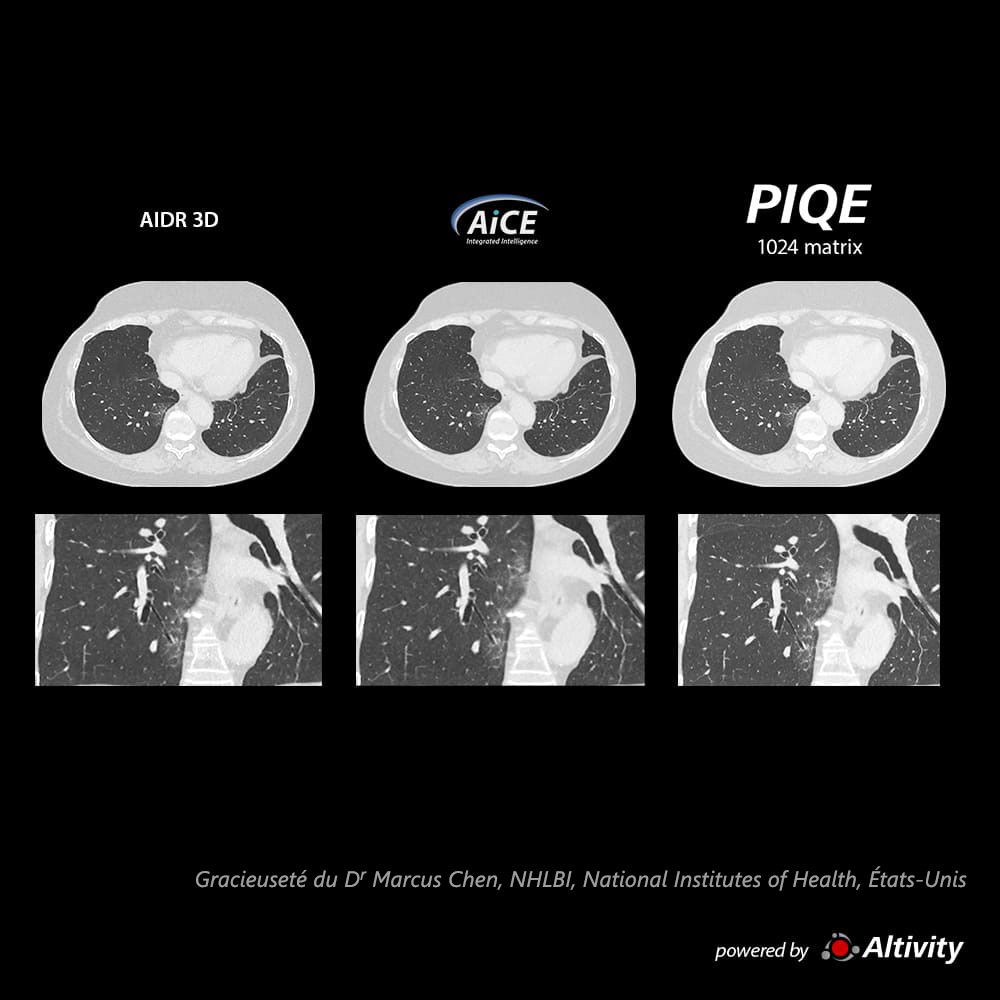 Piqe Cg Lung Fibrose