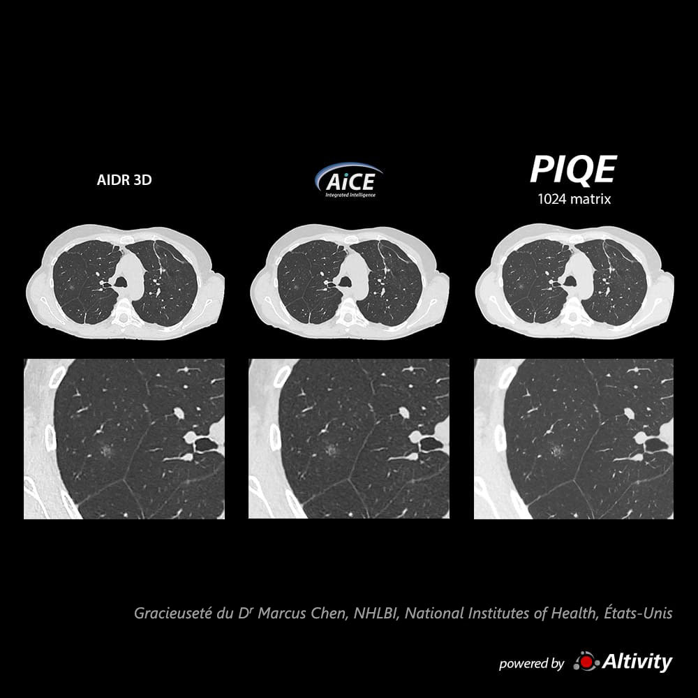 Piqe Cg Lung Infiltrat en verre dépoli