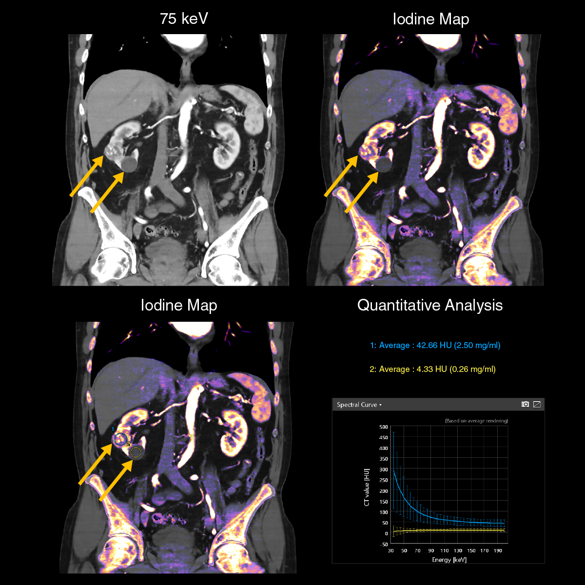 Kidney tumor