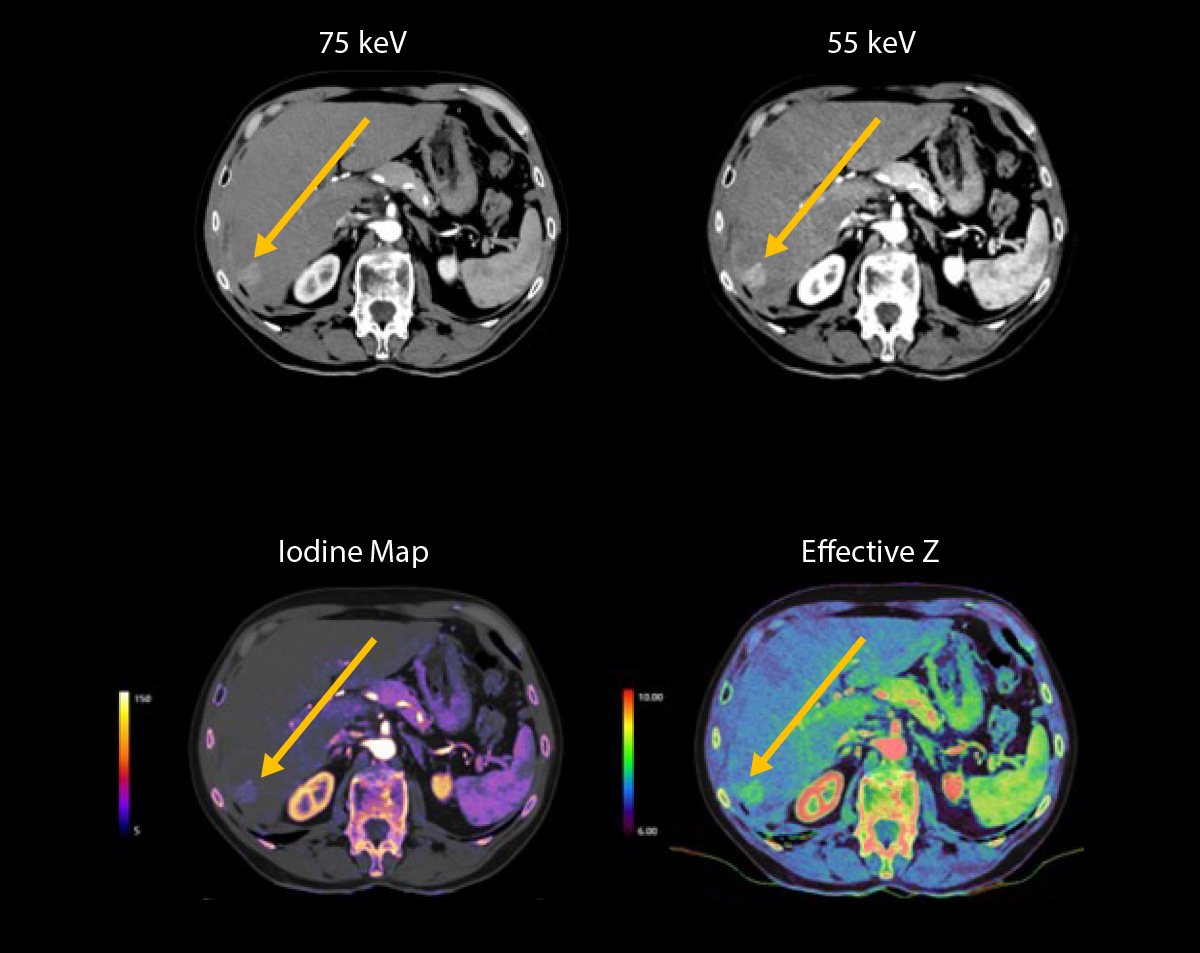 Hypervascular liver lesion