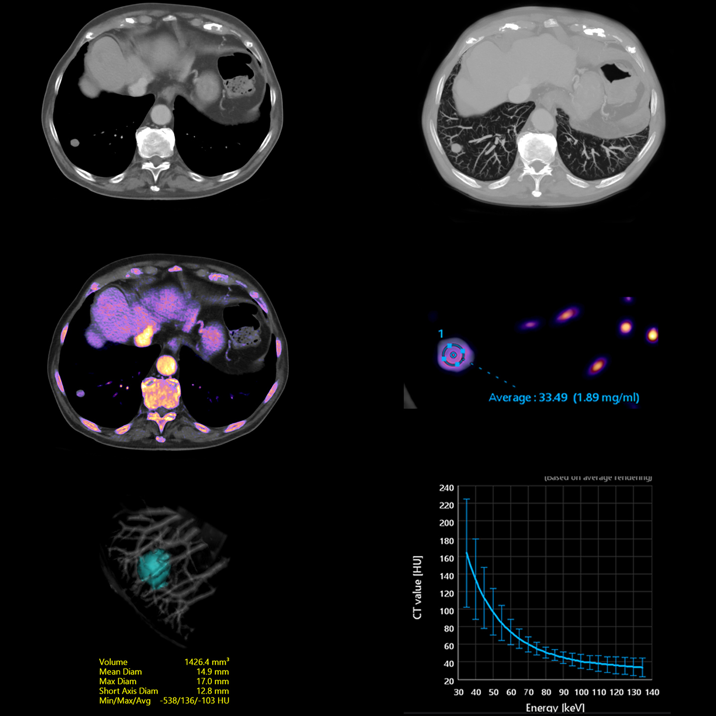 Aquilion ONE / PRISM Edition Nodule pulmonaire - analyse de la carte d'iode
