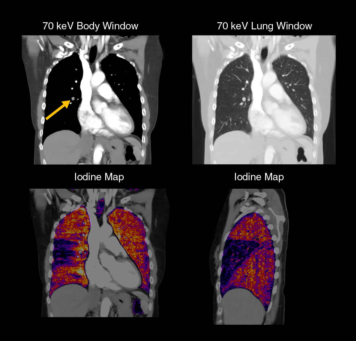 Spectral pulmonary embolism