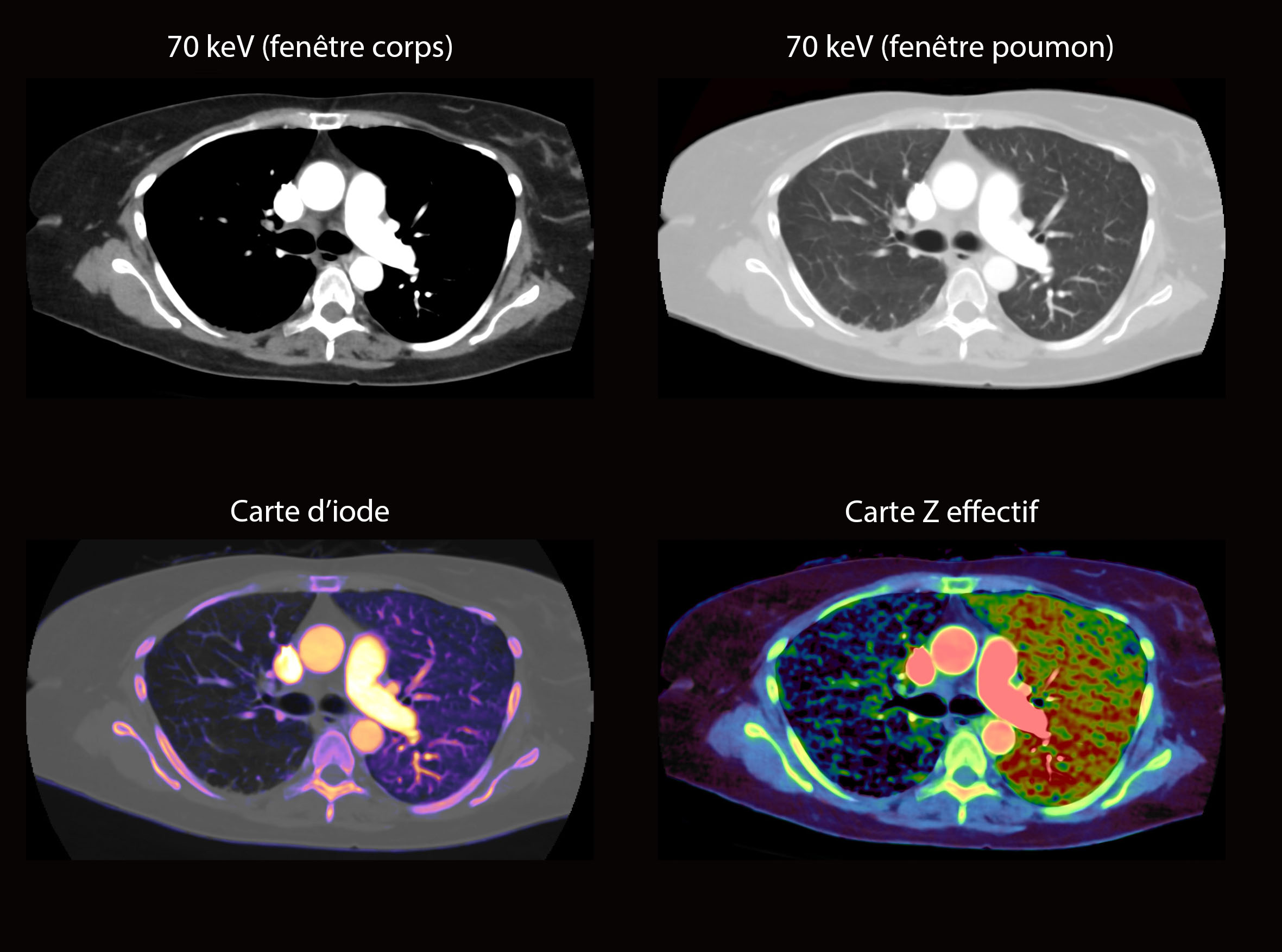 Aquilion ONE / PRISM Edition Absence congénitale de l'artère pulmonaire droite