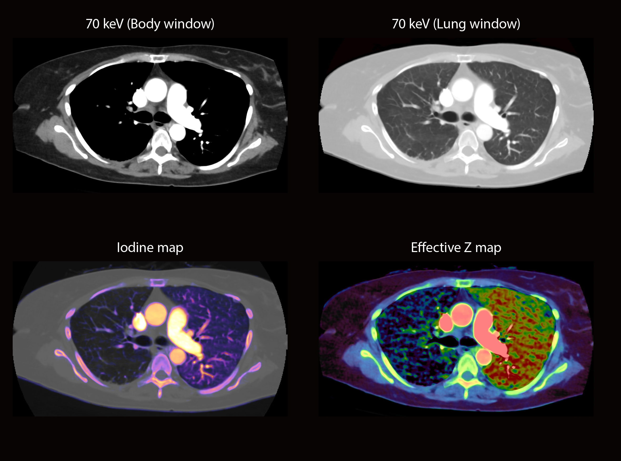 Congenital absence of right pulmonary artery