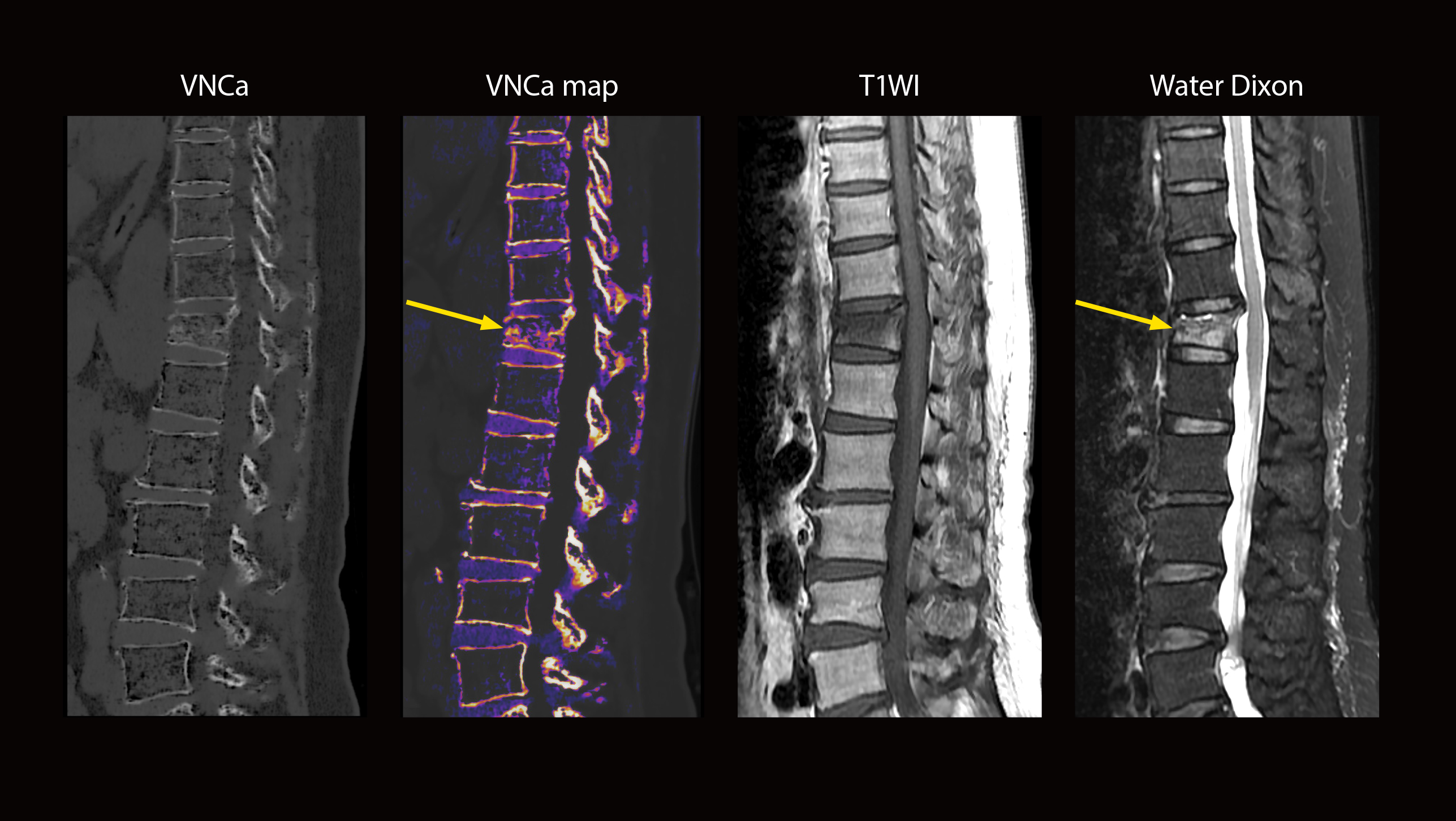 Acute compression fracture with bone marrow mapping