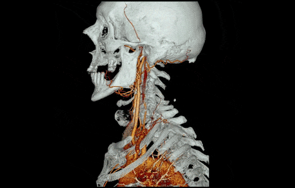 Angiography Cou