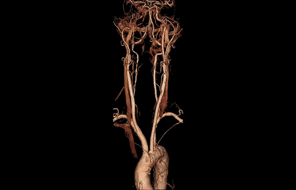 Angiography Cou