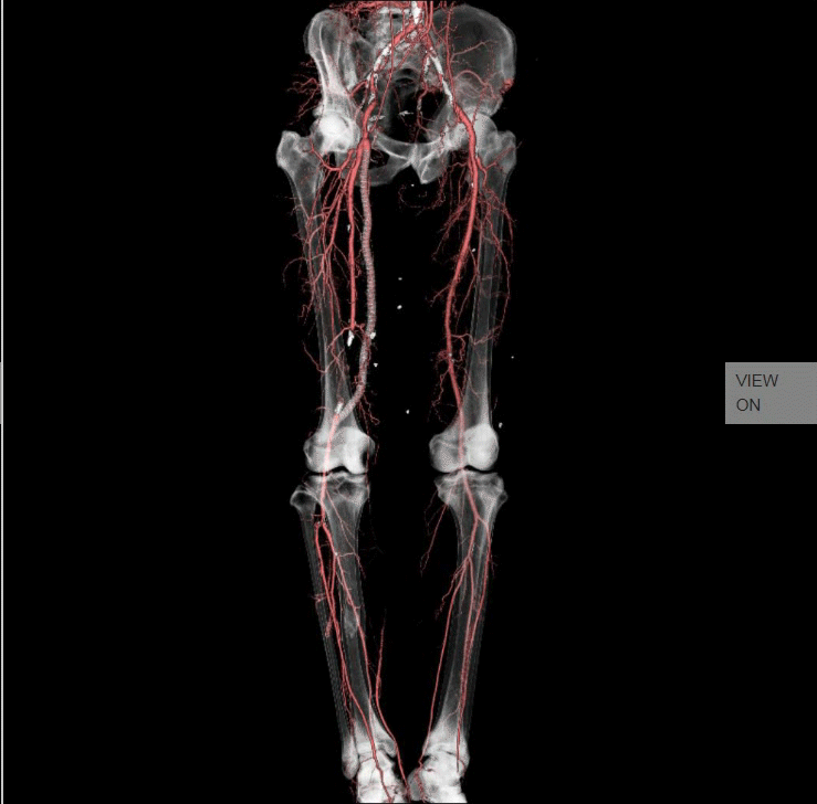 Angiography Run-off 1