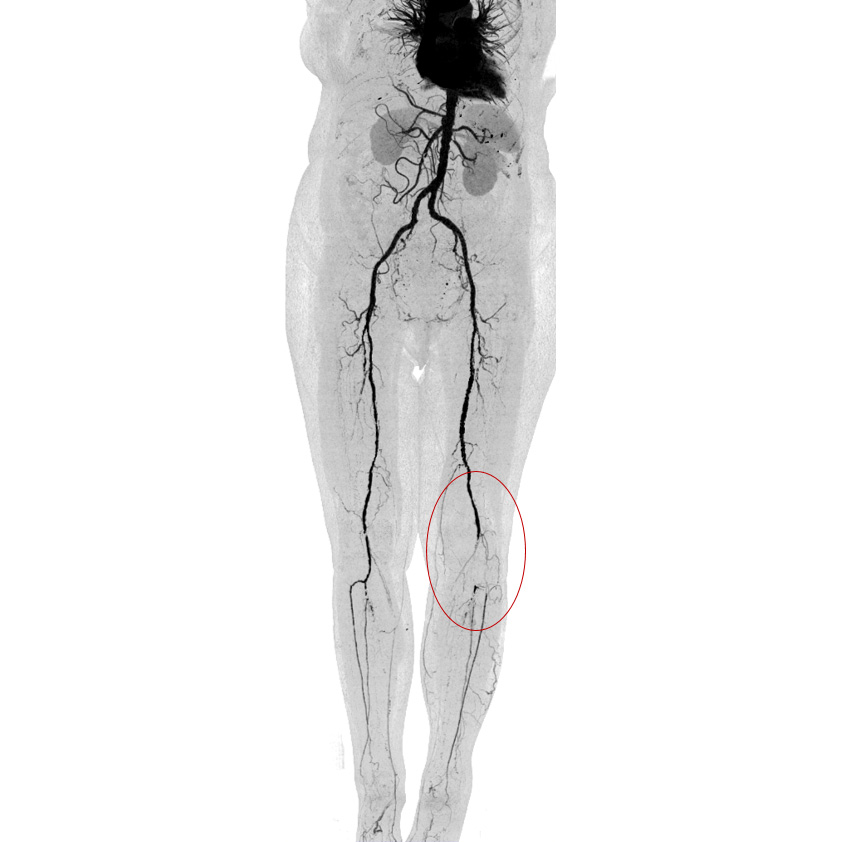 Angiography Run-off 2