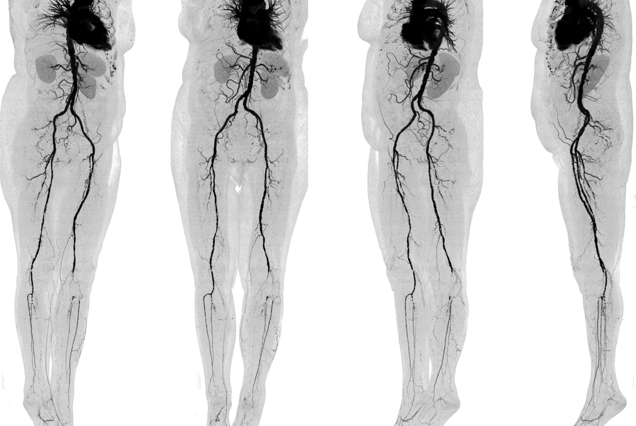 Angiography Run-off 2