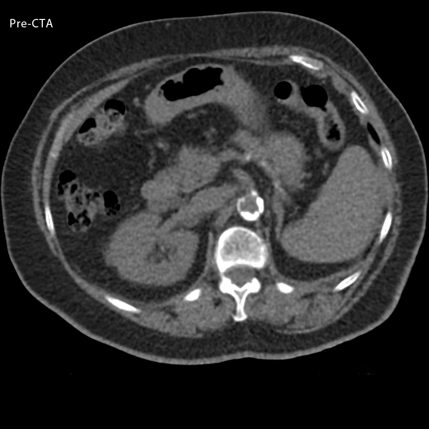 Angiography Run-off 2