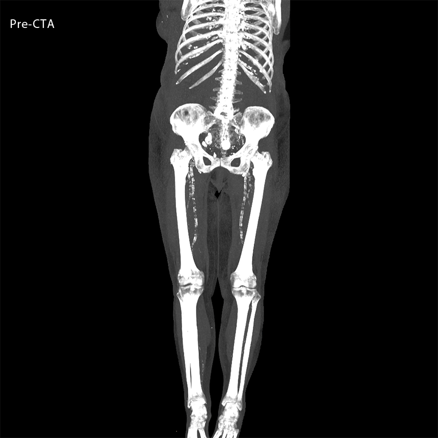 Angiography Run-off 2