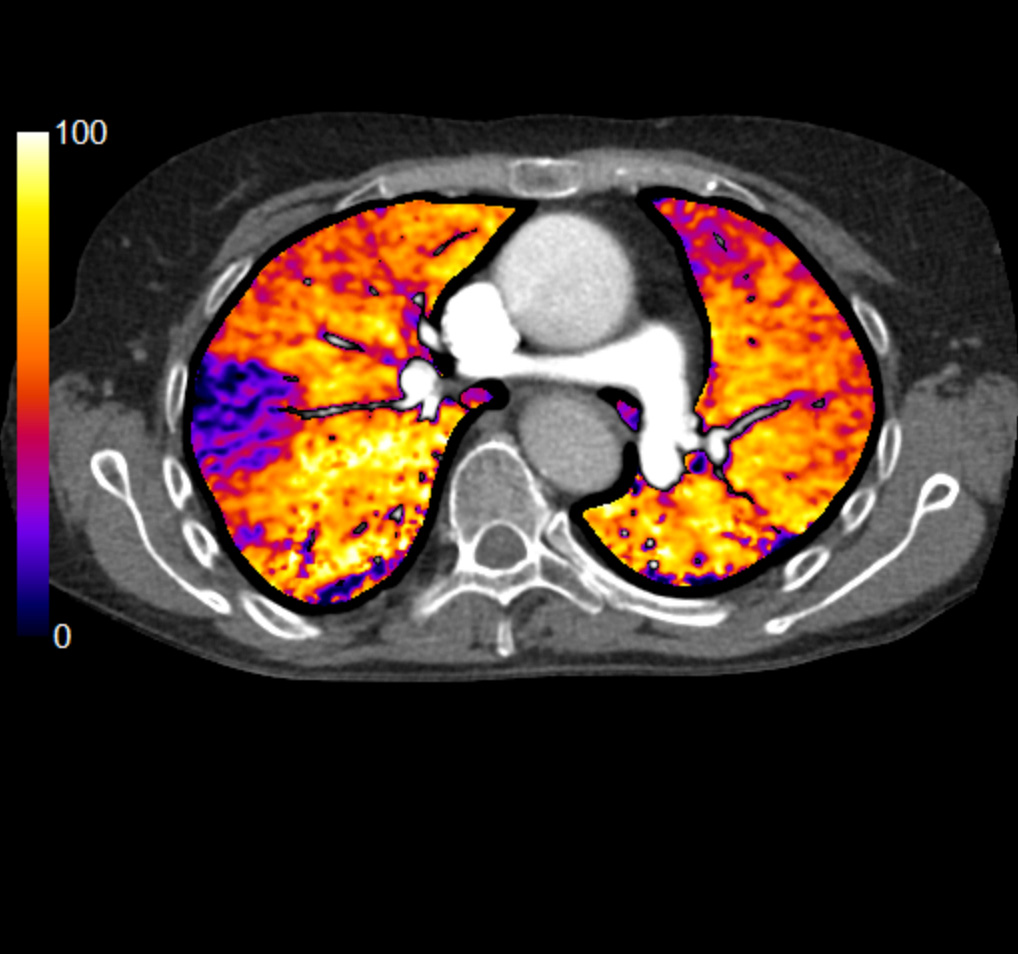 Iodine Mapping Poumon 1