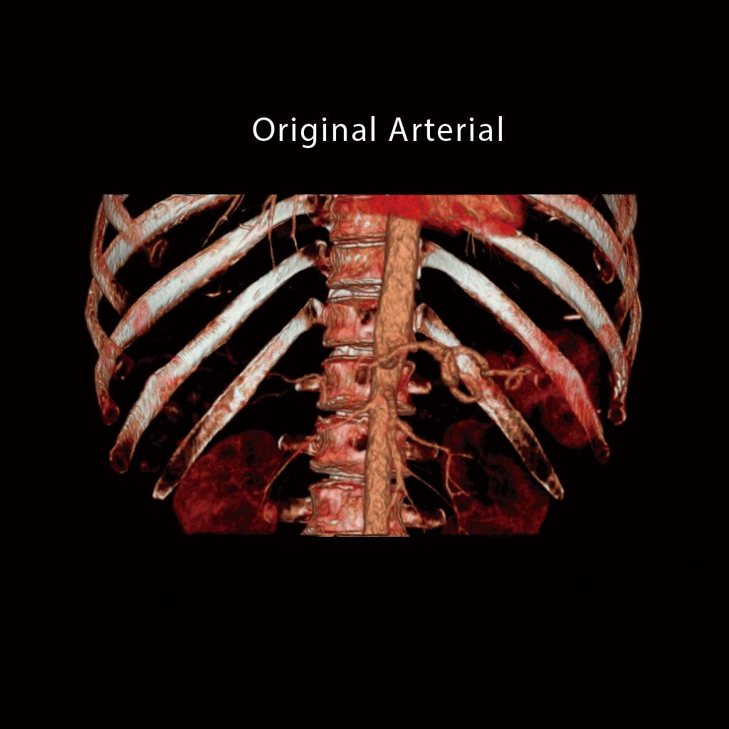 Iodine Mapping Rehaussement virtuel des contrastes