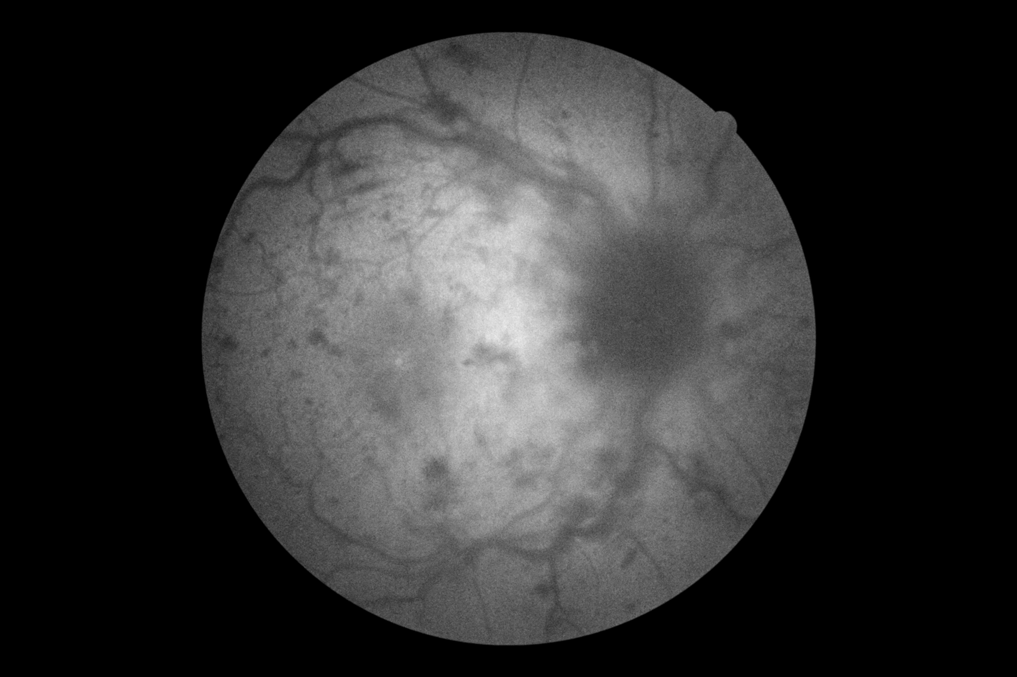 Central retinal vein occlusion 4