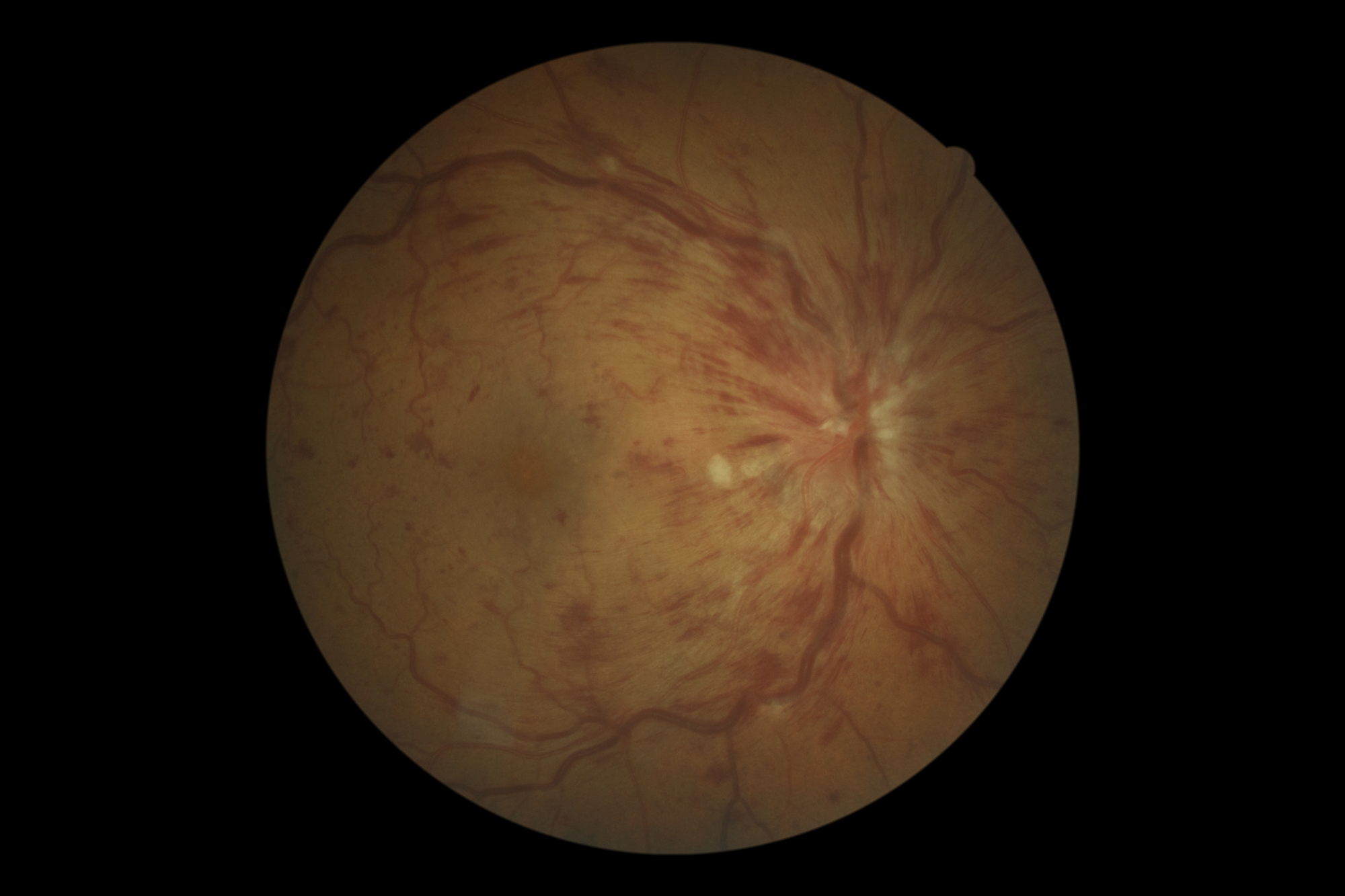 Central retinal vein occlusion 4
