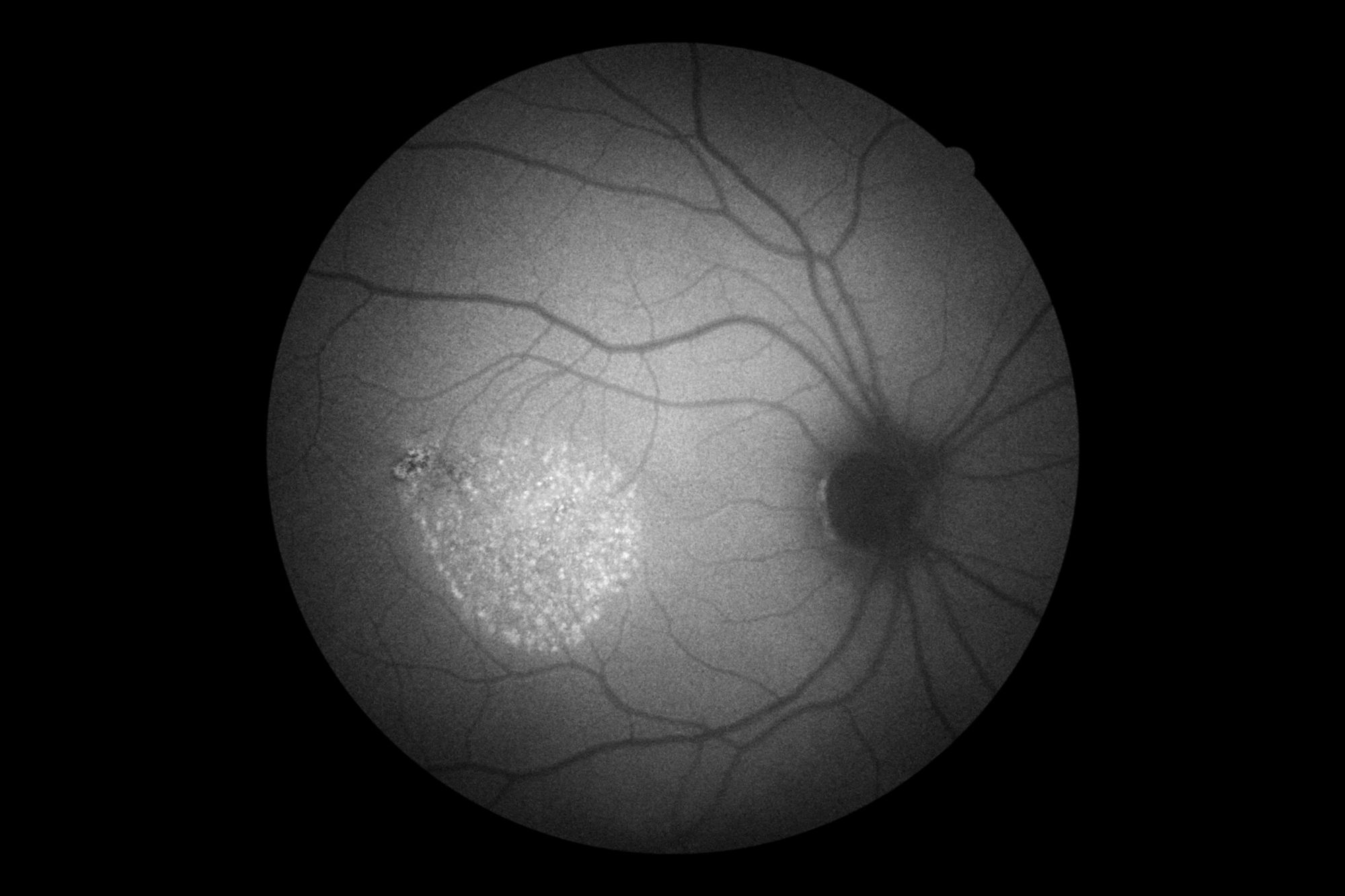 Chronic serous chorioretinopathy 3