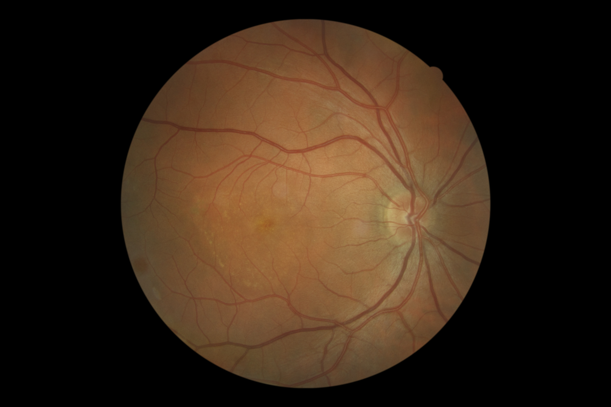 Chronic serous chorioretinopathy 3