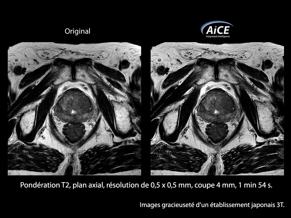 Aice 3t L'abdomen