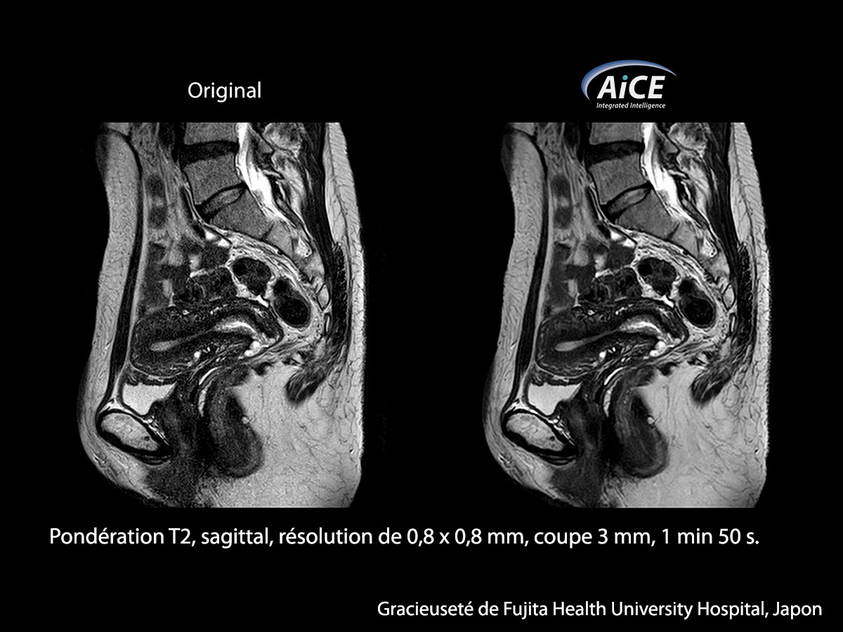 Aice 3t L'abdomen