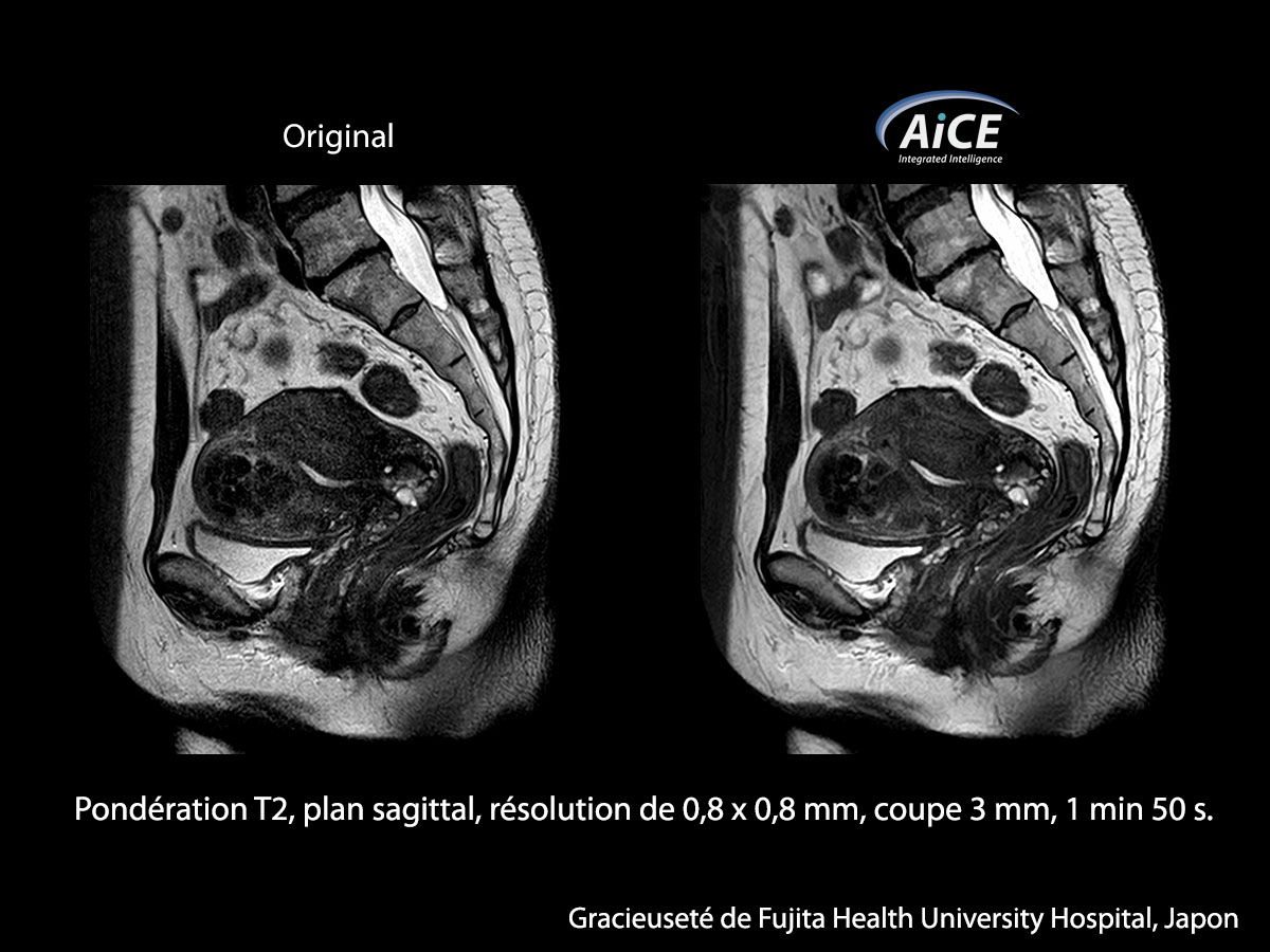 Aice 3t L'abdomen
