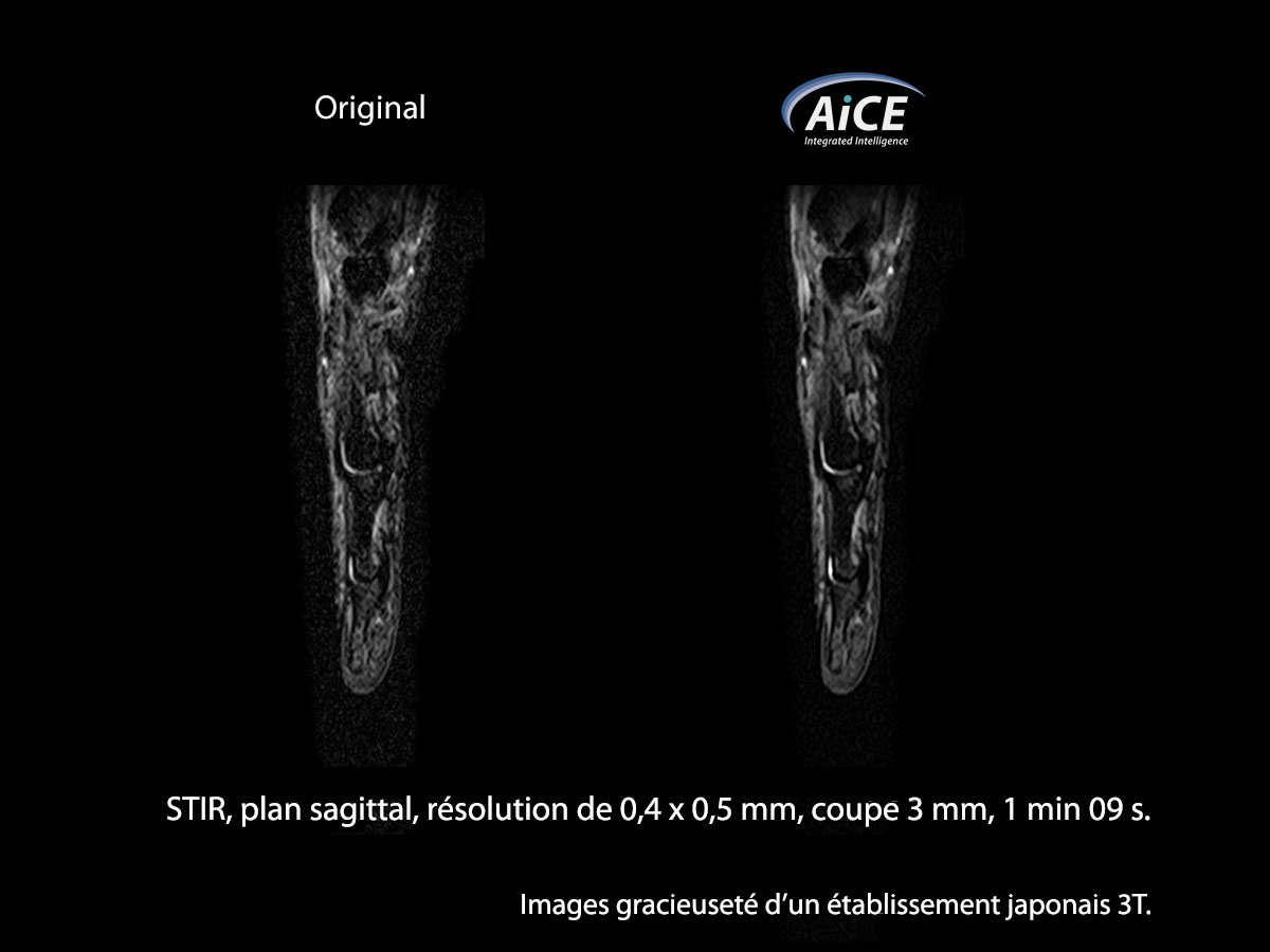 Aice 3t Musculosquelettique 1