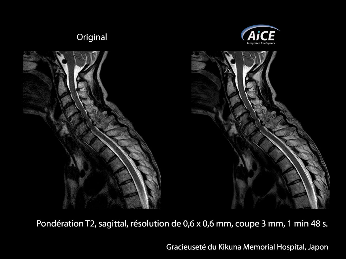 Aice 3t La colonne vertébrale