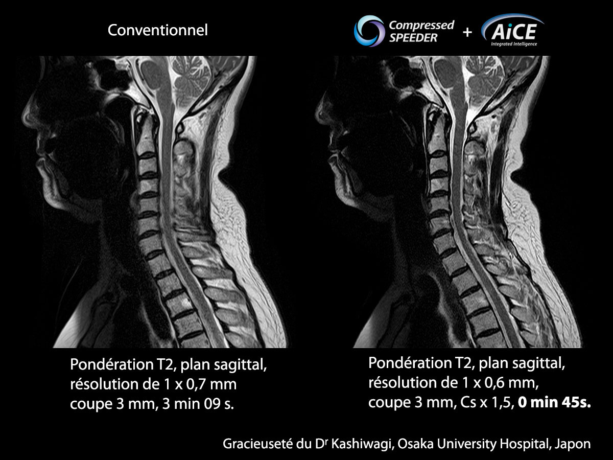 Aice Clinical Gallery La colonne vertébrale