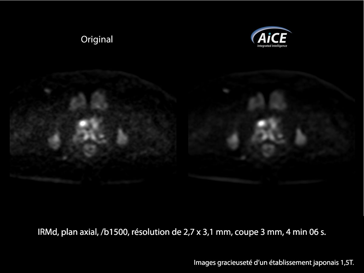 Aice Clinical Gallery Abdomen