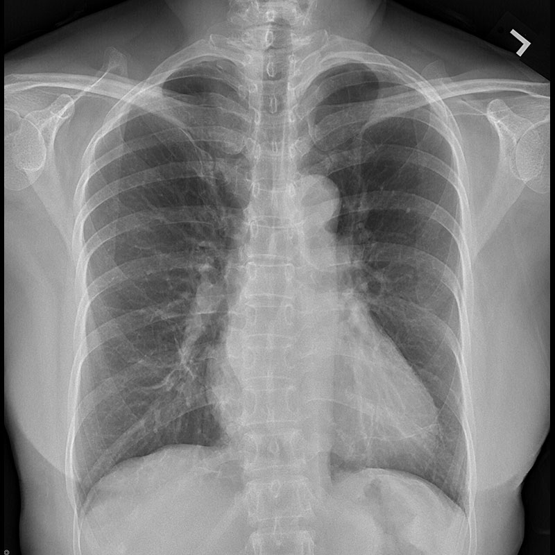 Systèmes de radiographie numérique CXDI Radiographie pulmonaire, femme