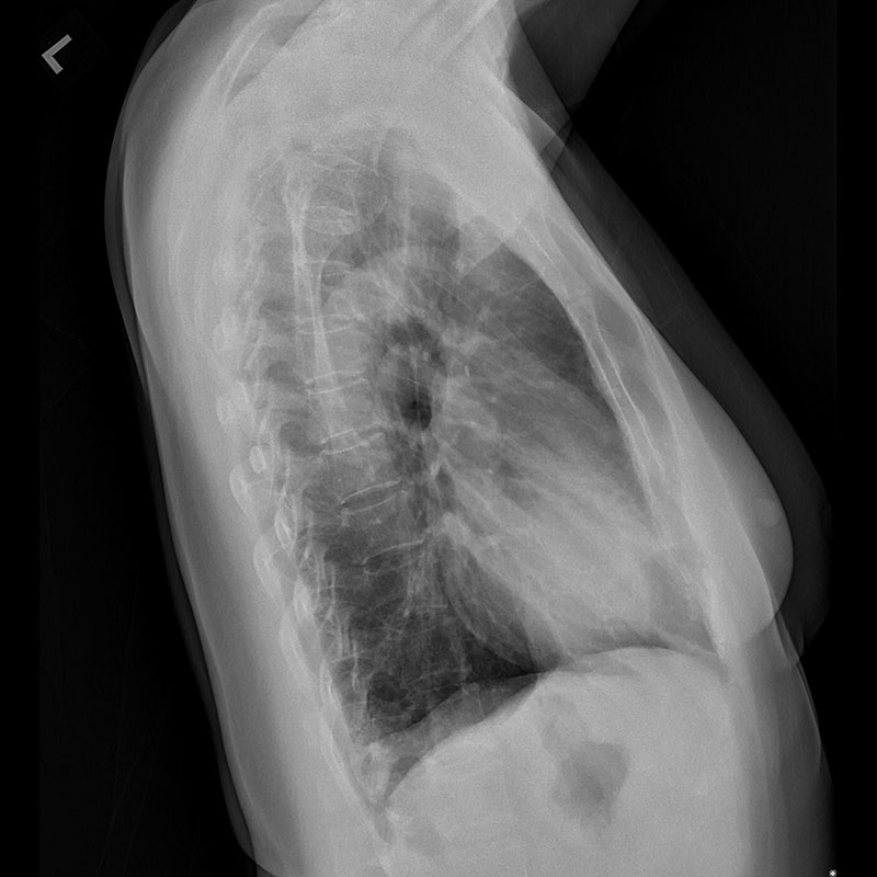 Systèmes de radiographie numérique CXDI Radiographie pulmonaire, femme