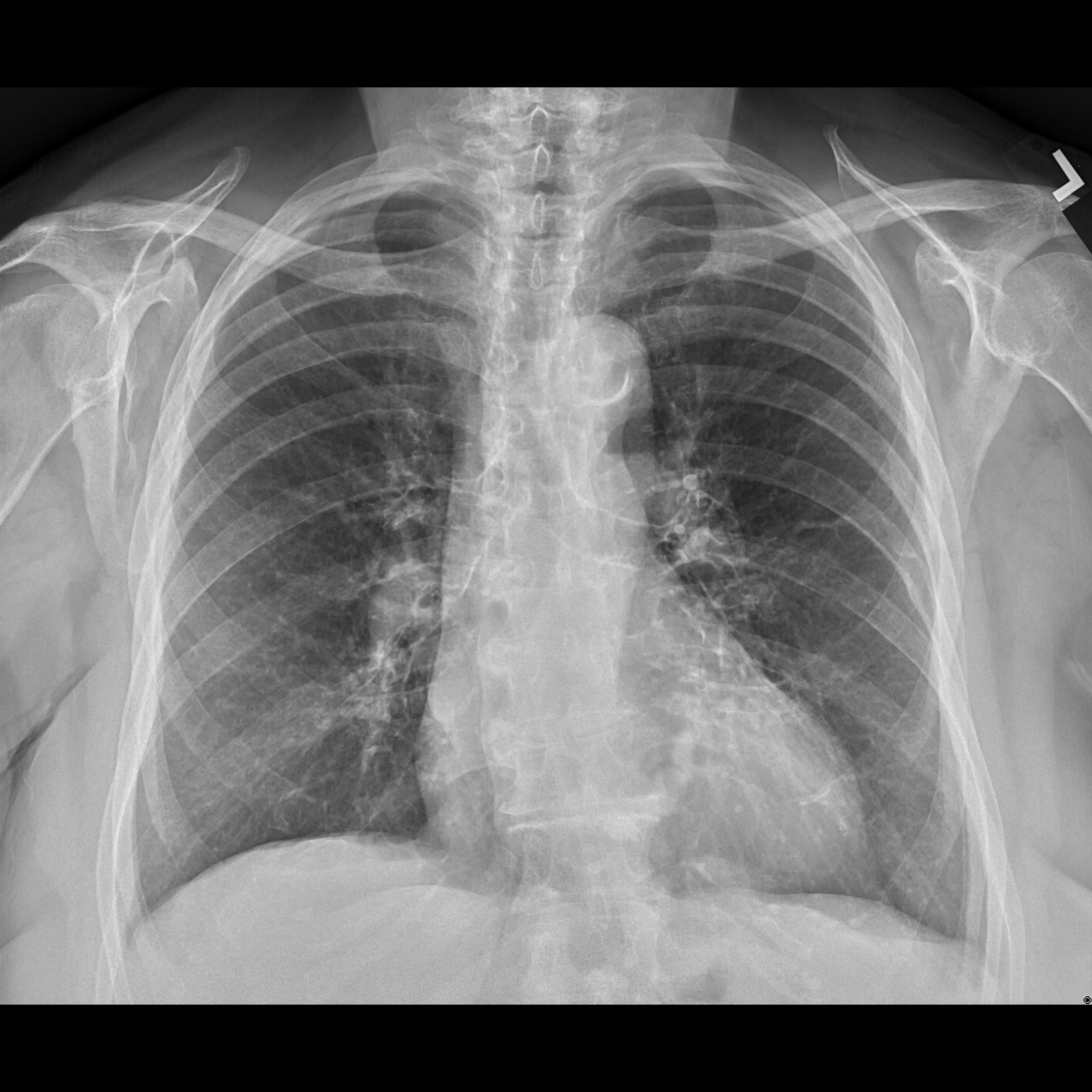Systèmes de radiographie numérique CXDI Radiographie pulmonaire, femme