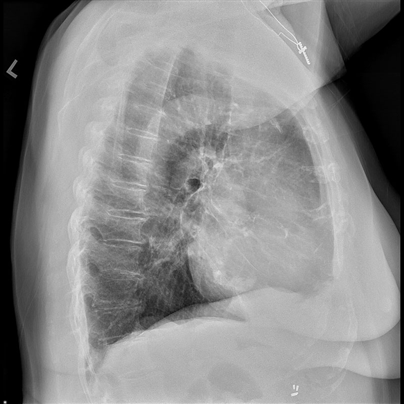 Systèmes de radiographie numérique CXDI Radiographie pulmonaire, femme