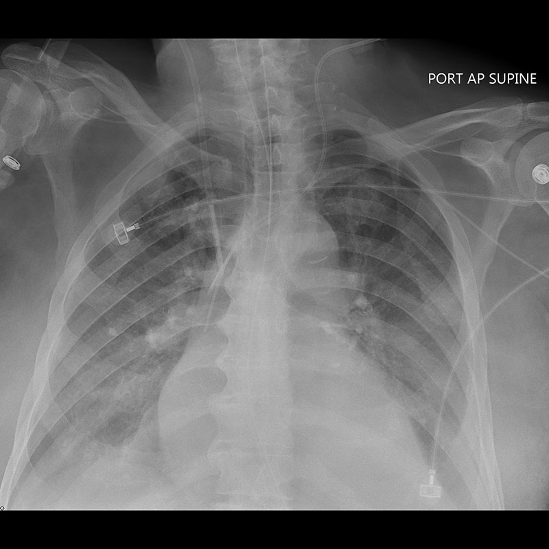 Systèmes de radiographie numérique CXDI Radiographie pulmonaire, avec correction de la diffusion et lignes rehaussées