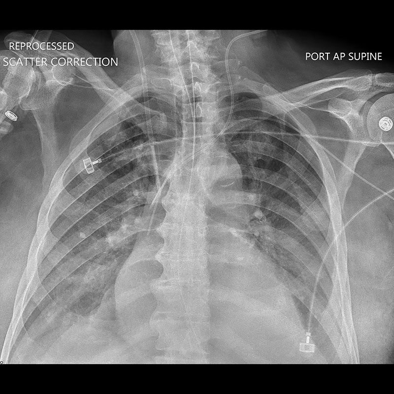 Systèmes de radiographie numérique CXDI Radiographie pulmonaire, avec correction de la diffusion et lignes rehaussées
