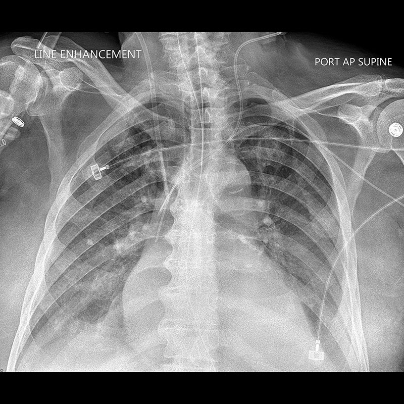 Systèmes de radiographie numérique CXDI Radiographie pulmonaire, avec correction de la diffusion et lignes rehaussées