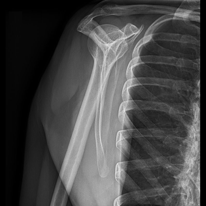 Systèmes de radiographie numérique CXDI Épaule