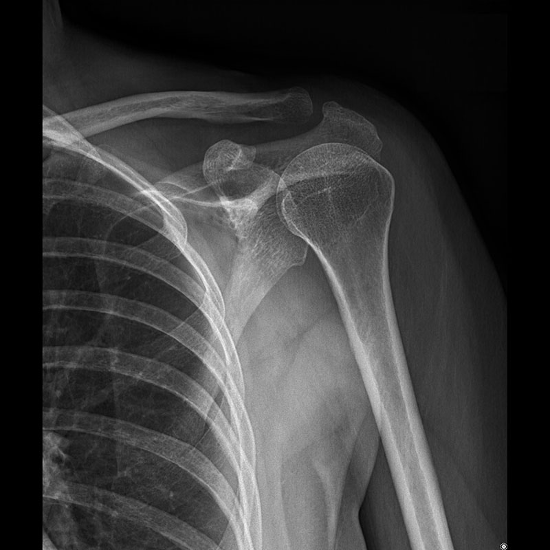 Systèmes de radiographie numérique CXDI Épaule