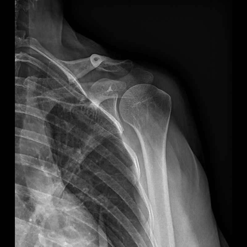 Systèmes de radiographie numérique CXDI Épaule