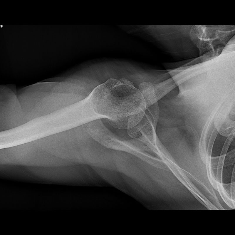 Systèmes de radiographie numérique CXDI Épaule
