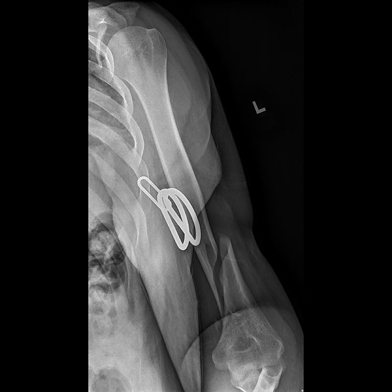 Systèmes de radiographie numérique CXDI Humérus