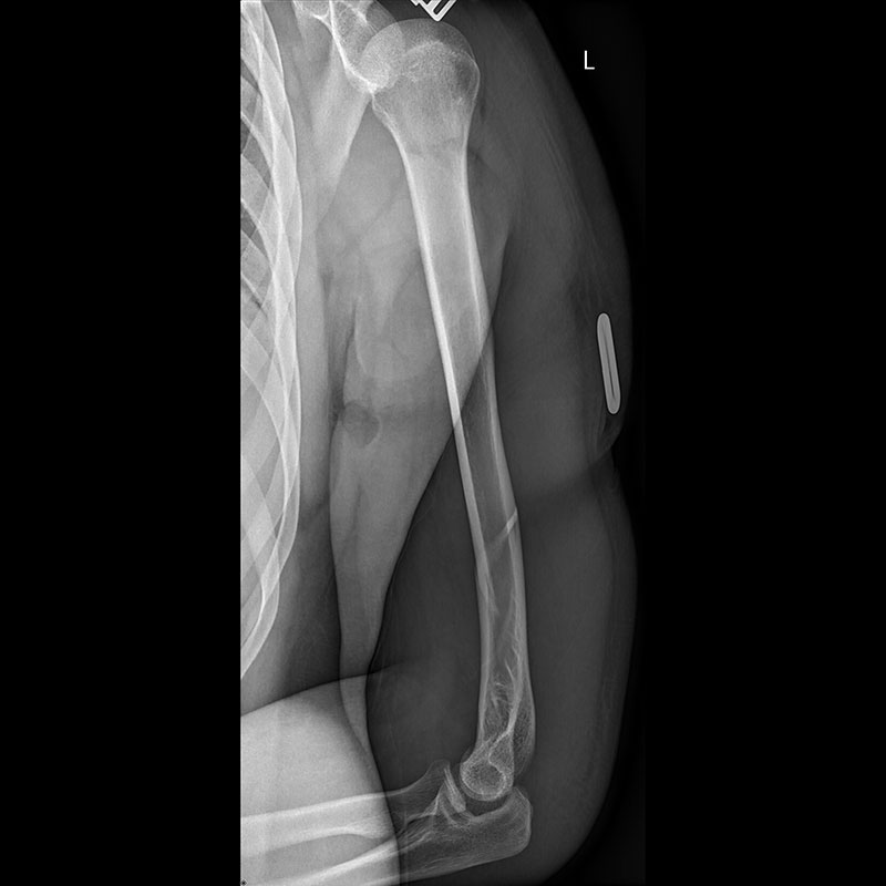 Systèmes de radiographie numérique CXDI Humérus