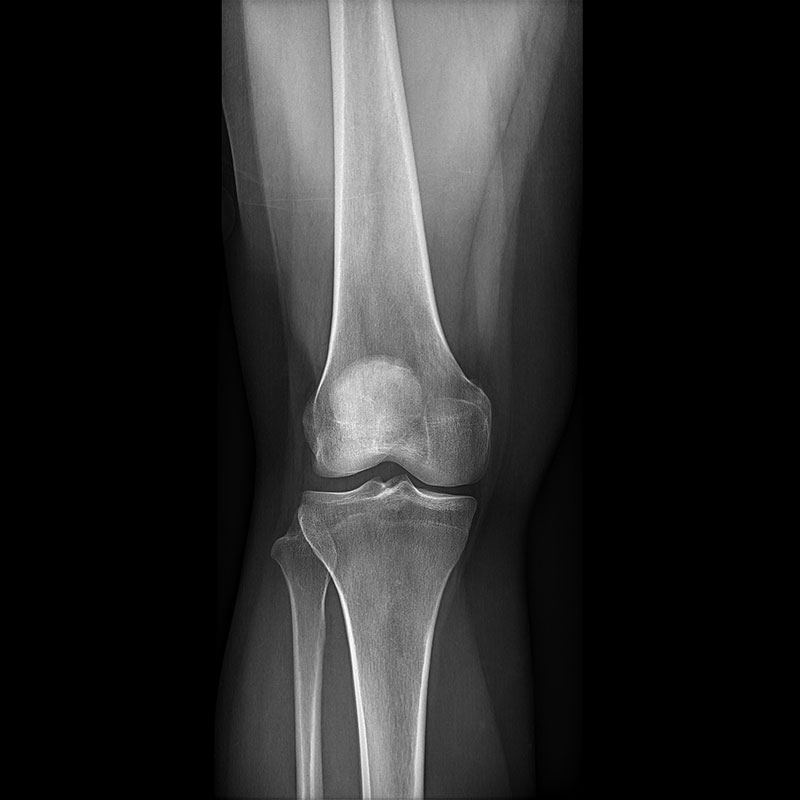 Systèmes de radiographie numérique CXDI Genou