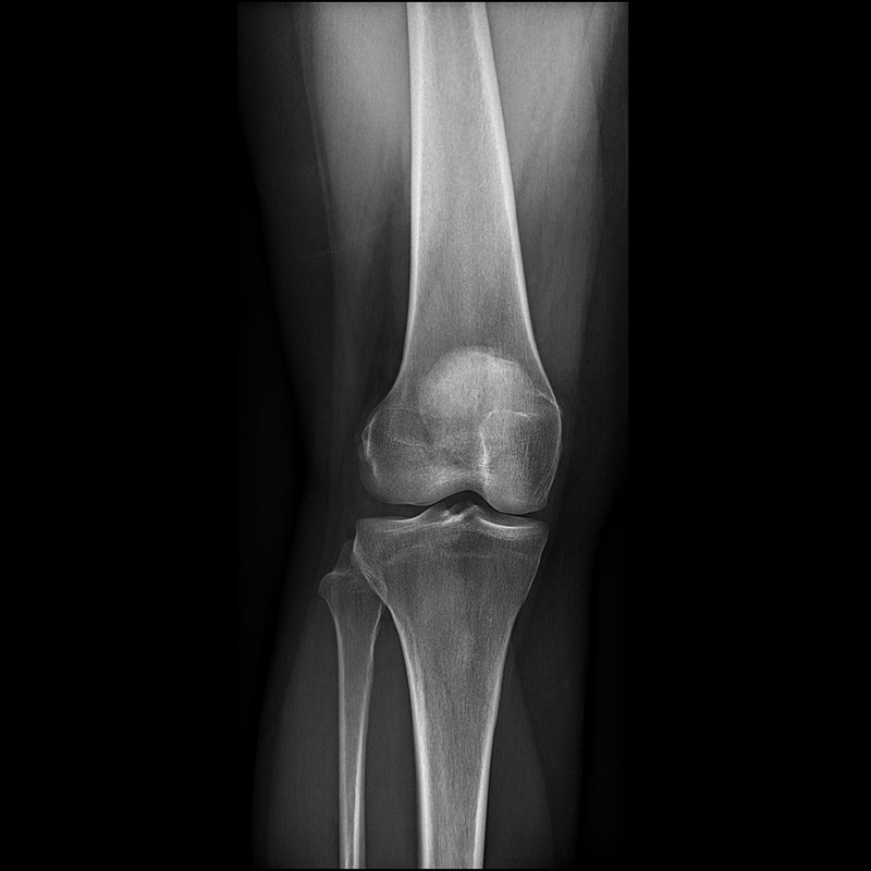 Systèmes de radiographie numérique CXDI Genou